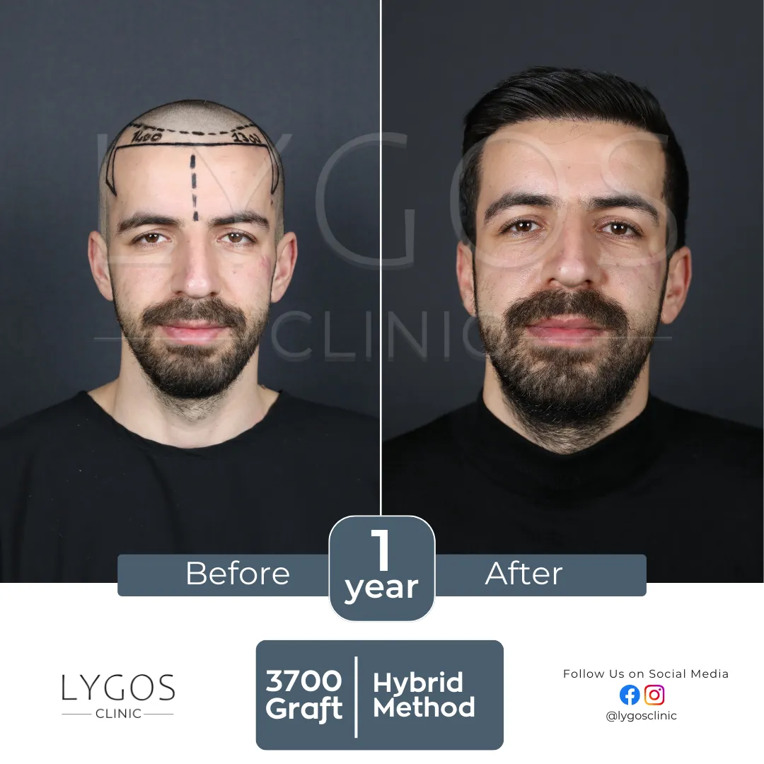 Saç Ekimi 21 lygos hair transplant before and after images