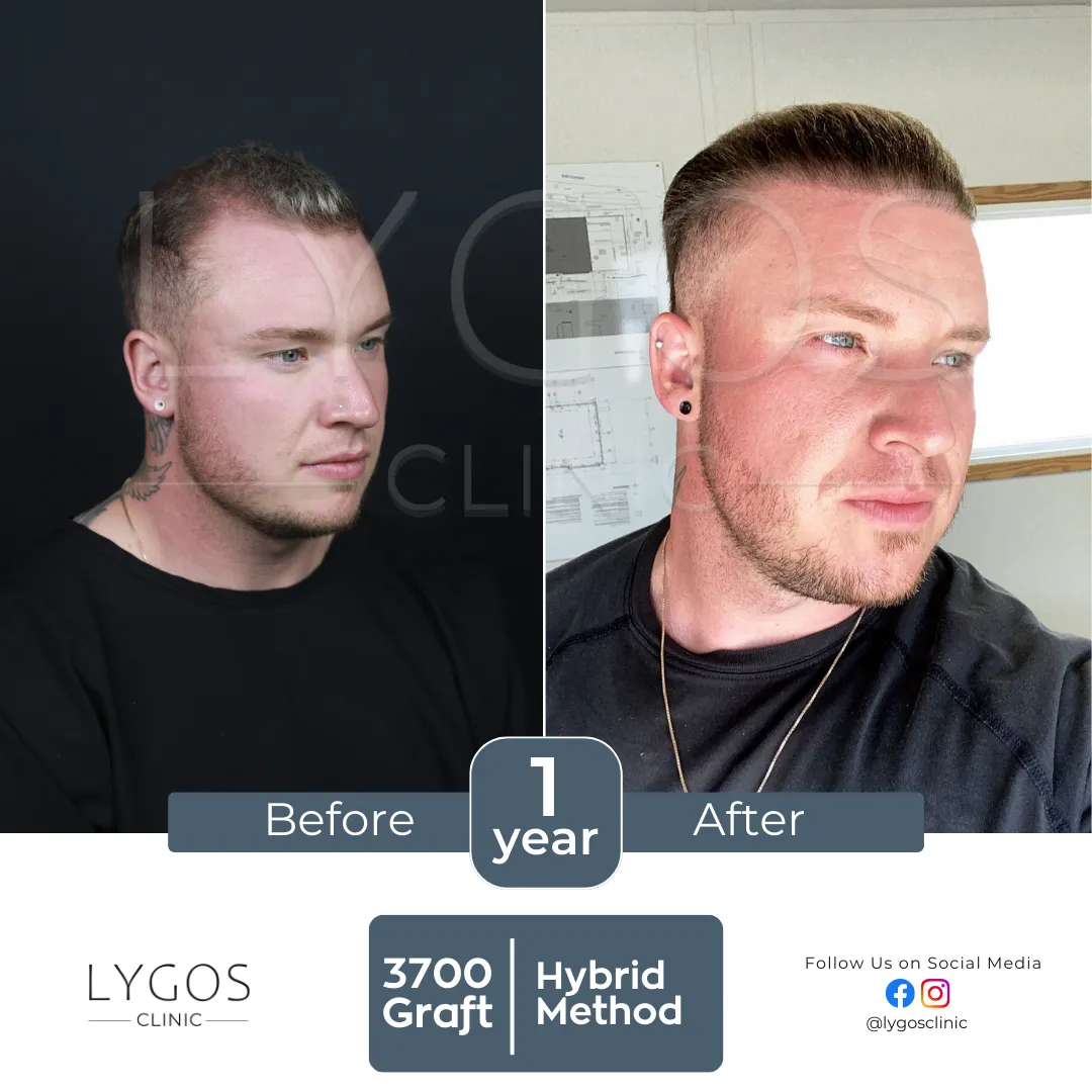 Saç Ekimi 10 lygos hair transplant before and after images