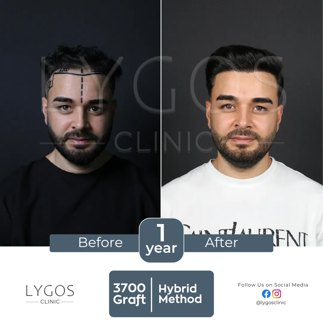 Saç Ekimi 11 lygos hair transplant before and after images