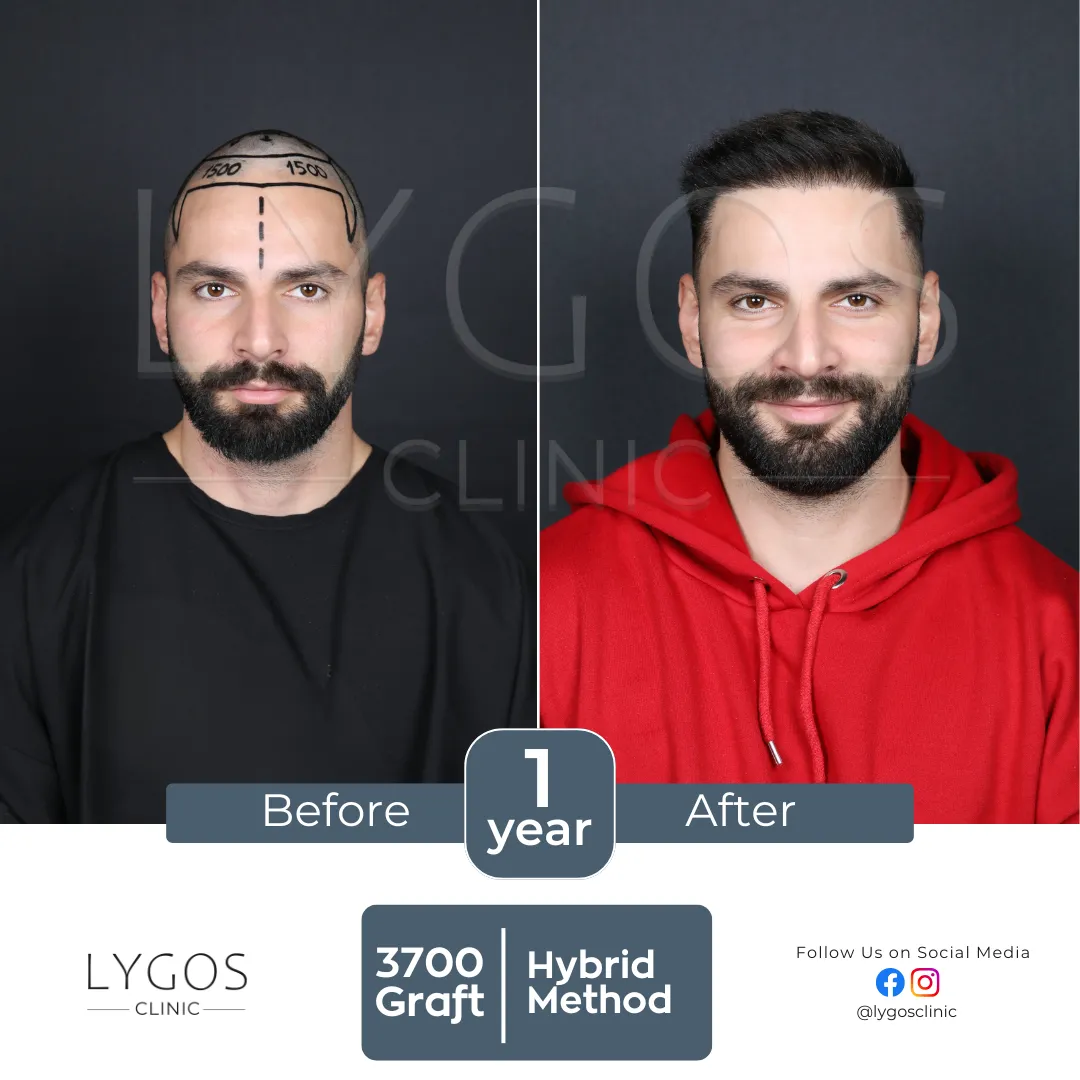 Saç Ekimi 12 lygos hair transplant before and after images