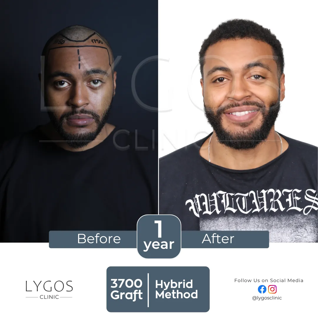 Saç Ekimi 13 lygos hair transplant before and after images