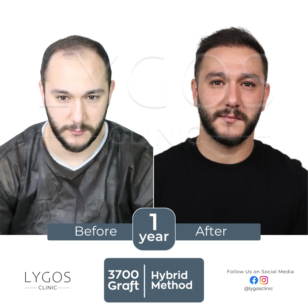 Saç Ekimi 14 lygos hair transplant before and after images