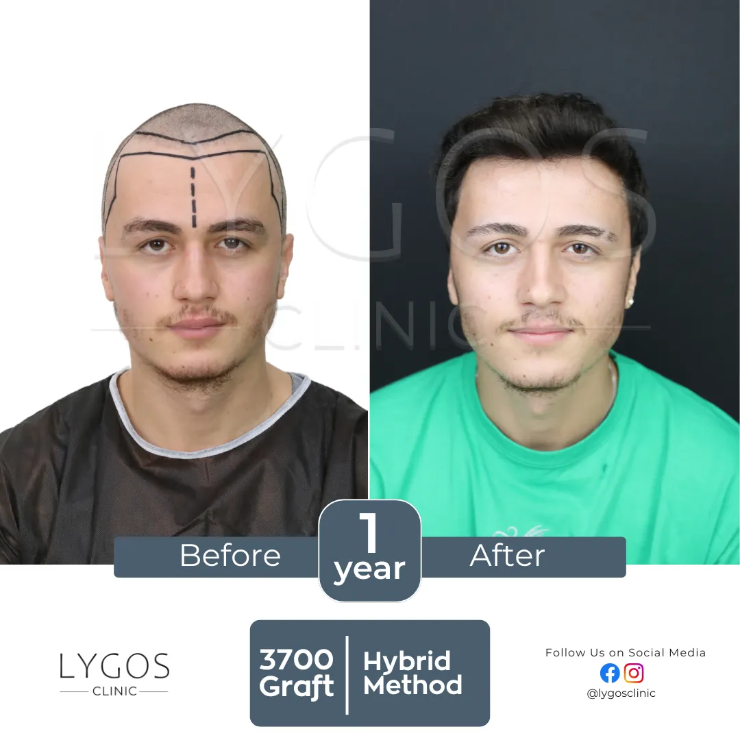 Saç Ekimi 15 lygos hair transplant before and after images