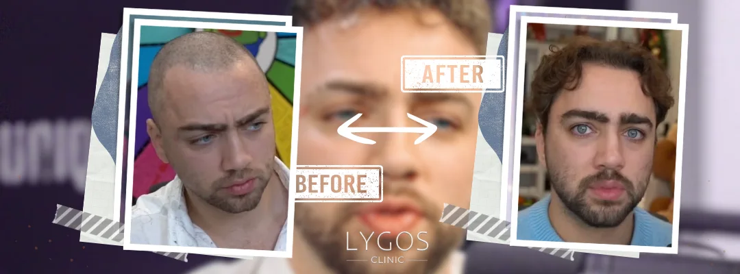 Mizkif Before and After Hair Transplant