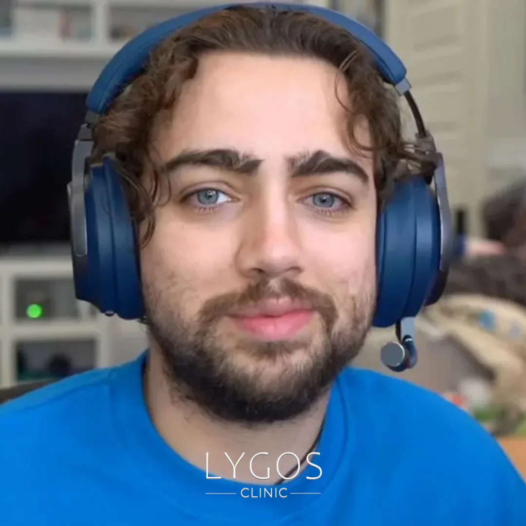 Mizkif Hair Transplant