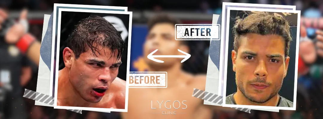 Paulo Costa Hair Transplant | Celebrities Hair Transplant 4 Paulo Costa Before and After Hair Transplant