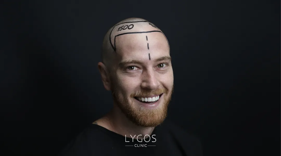 Saç Ekimi 22 sapphire fue hair transplant hair line