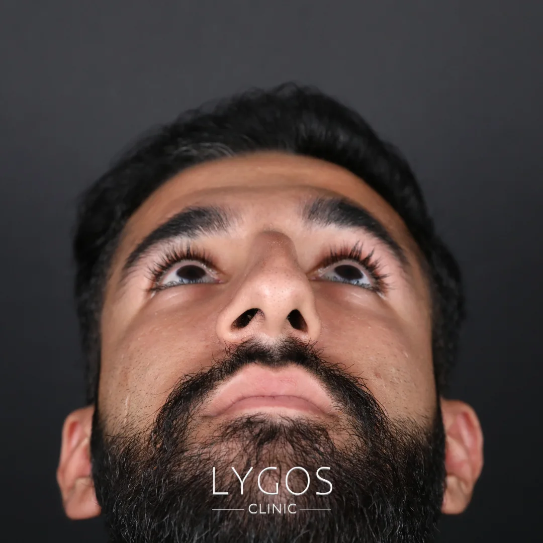 Things to Consider After Nasal Deviation Surgery 1 Things to Consider After Nasal Deviation Surgery