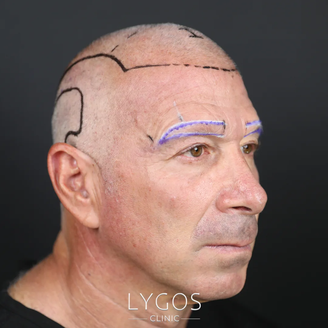 Things to Know Before and After Eyebrow Transplantation 1 Things to Know Before and After Eyebrow Transplantation