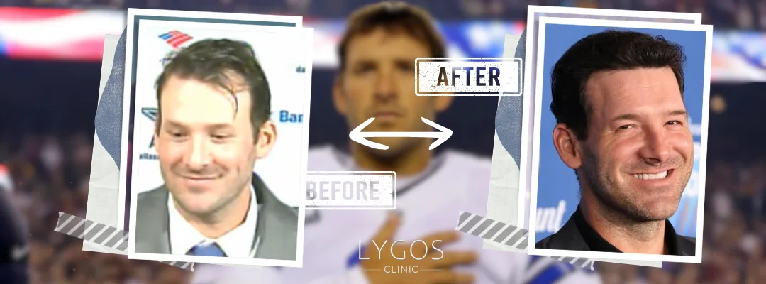 Tony Romo Hair Transplant | Celebrities Hair Transplant 4 Tony Romo Before and After Hair Transplant
