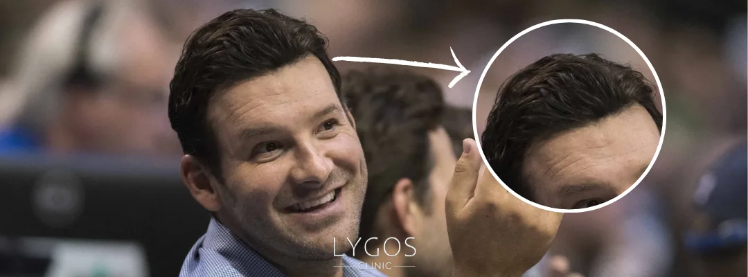 Tony Romo Hair Transplant | Celebrities Hair Transplant 3 Did Tony Romo Get a Hair Transplant?