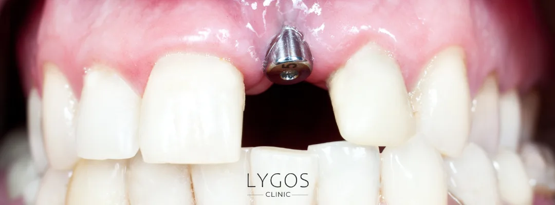 What Causes a Loose Tooth? 3 Treatment Options for a Loose Tooth