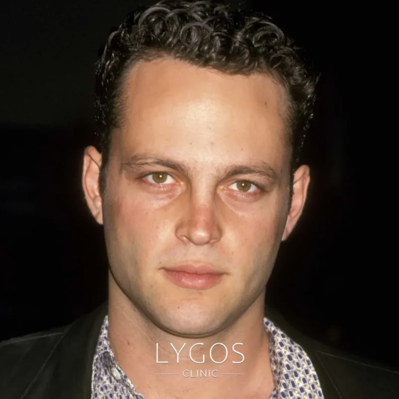 Vince Vaughn Saç Ekimi
