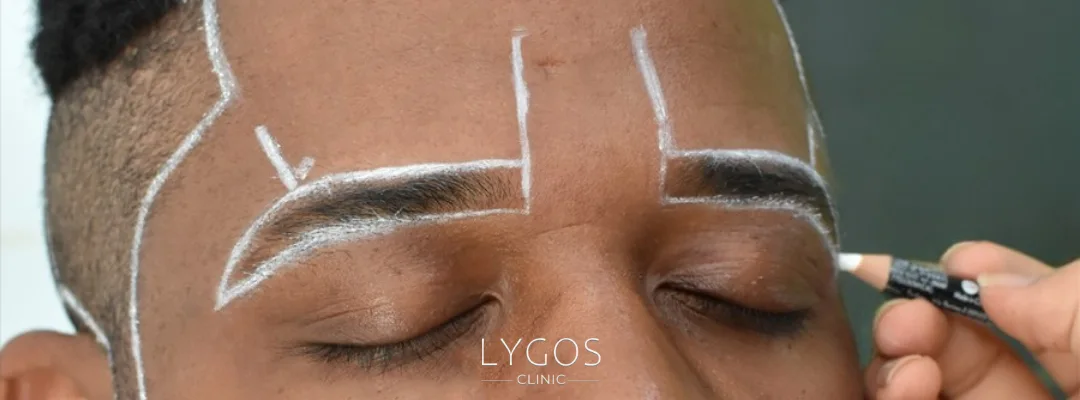 Things to Know Before and After Eyebrow Transplantation 2 What is Eyebrow Transplantation?