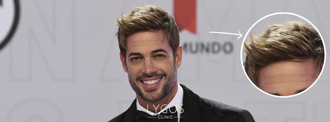 William Levy Saç Ekimi | Ünlülerde Saç Ekimi 3 William Levy Saç Ekimi Yaptırdı mı?