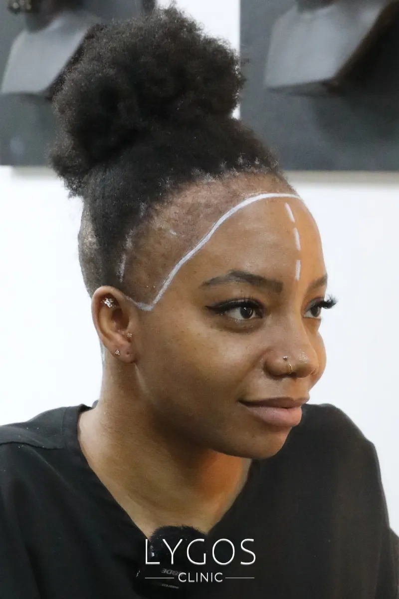 Saç Ekimi 35 woman afro hair transplant before