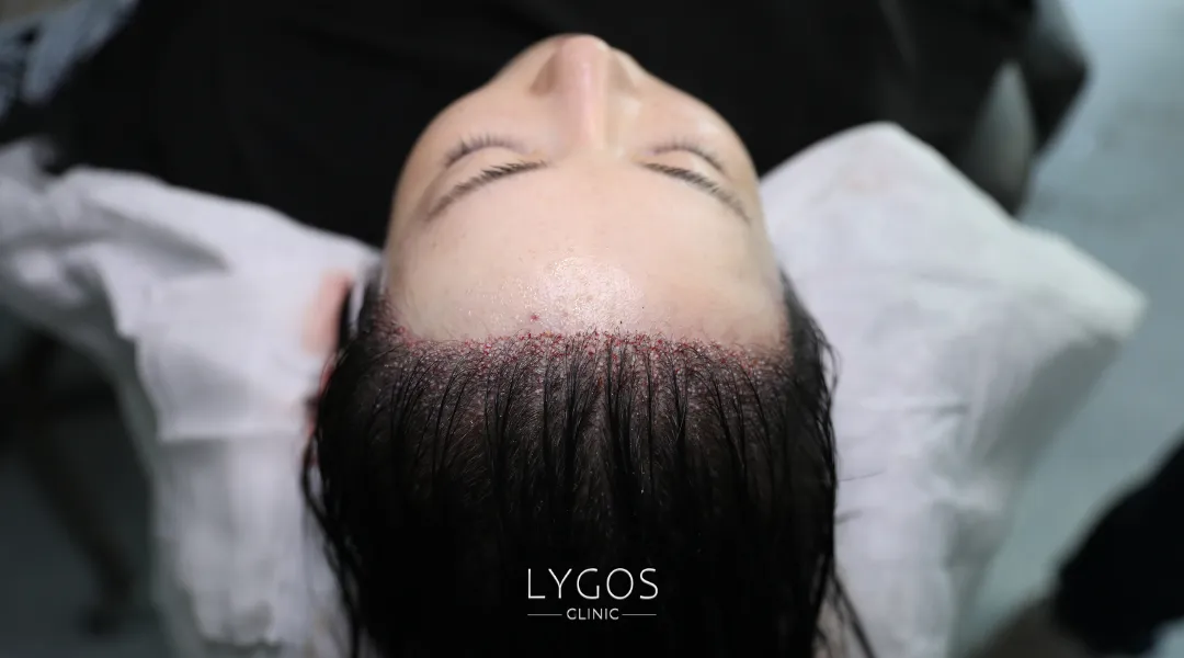 Saç Ekimi 29 woman hair transplant