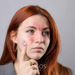Post Bariatric Surgery 21 What is Rosacea