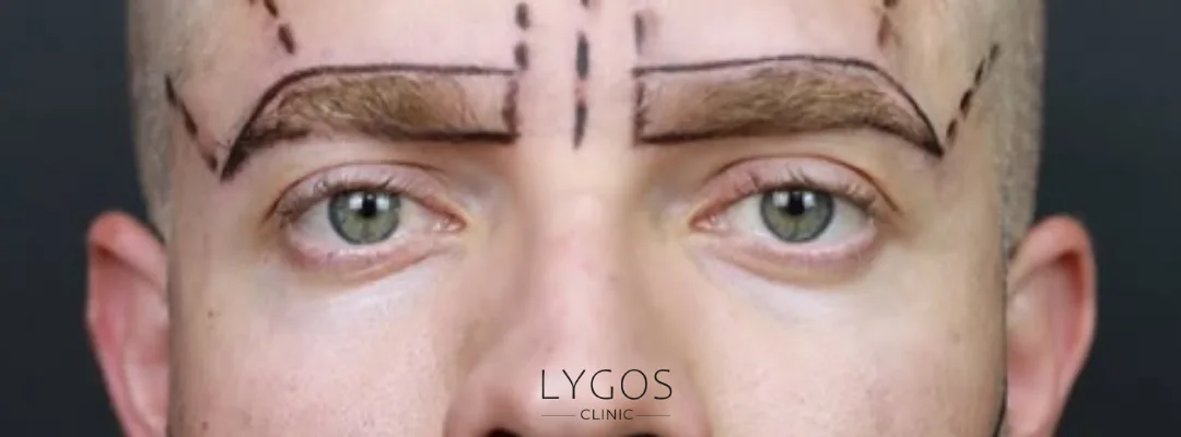 Kaş Ekimi Yöntemleri | Kaş Ekimi Sonrası İyileşme Süreci 2 What is Eyebrow Transplant?