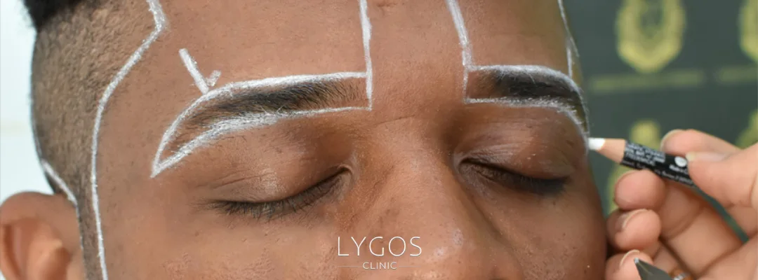 Kaş Ekimi Yöntemleri | Kaş Ekimi Sonrası İyileşme Süreci 3 Eyebrow Transplant Methods
