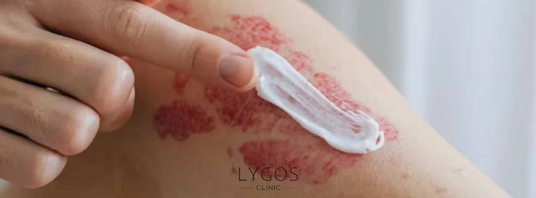 Sedef Hastalığı Nedir? | Sedef Belirtileri ve Tedavisi 4 What Are the Treatment Methods for Psoriasis?