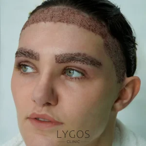 Eyebrow Transplant 18 Eyebrow Transplant Methods