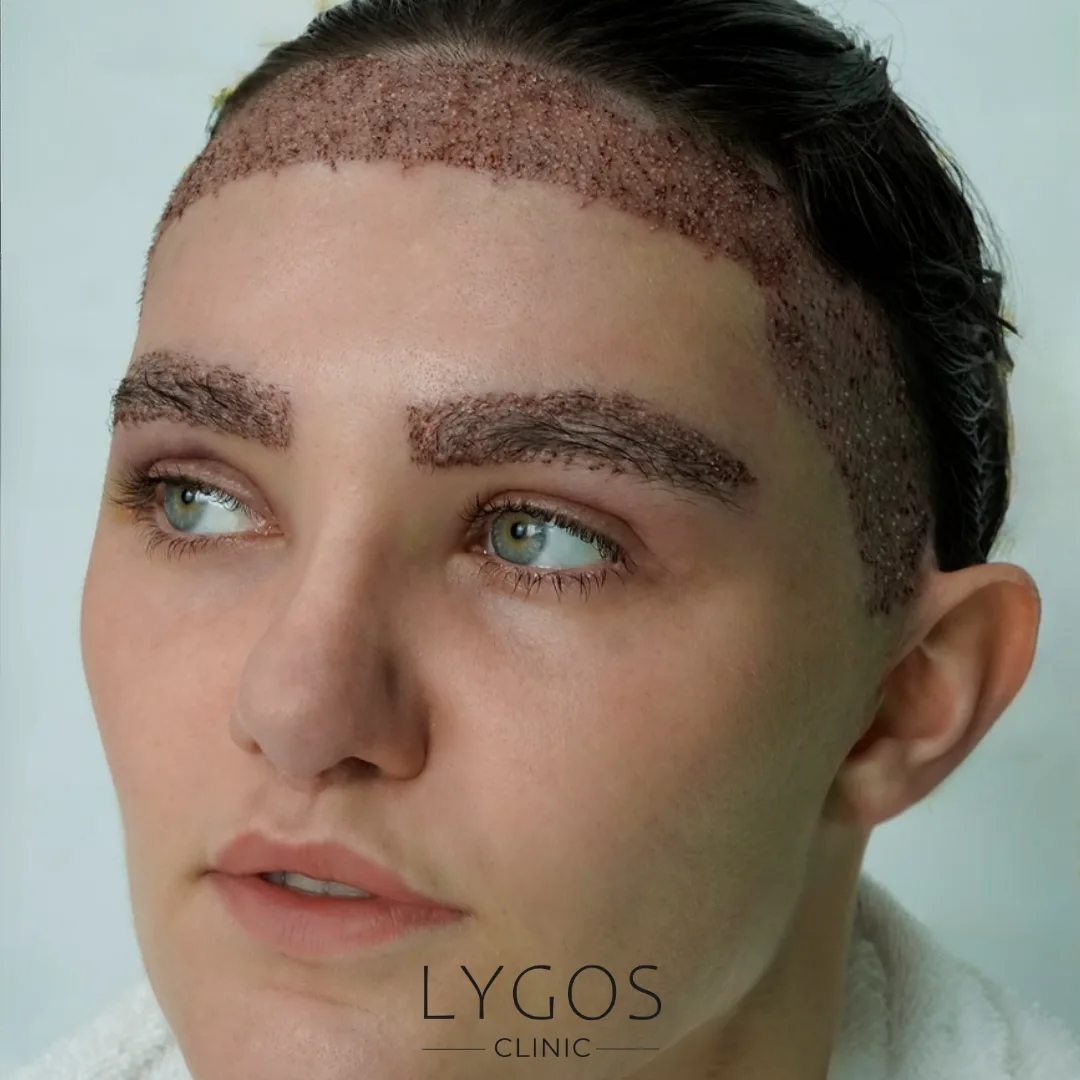 Eyebrow Transplant Methods