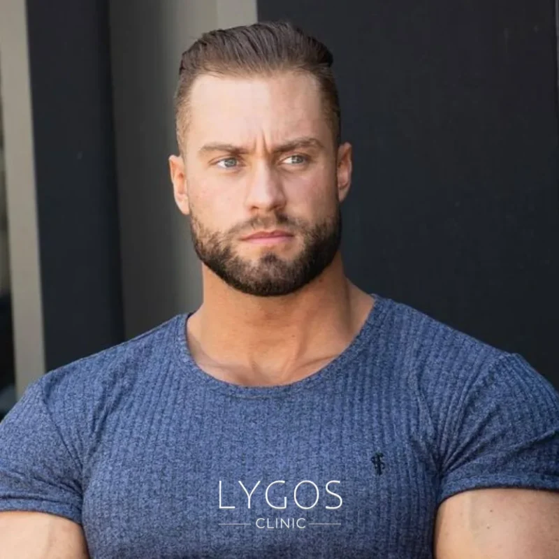 Chris Bumstead Hair Transplant