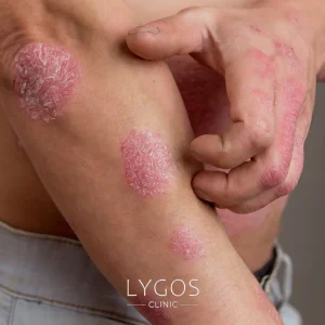 Astigmatism 29 What is Psoriasis?