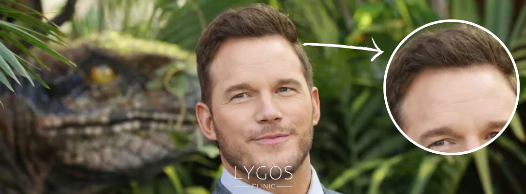 Chris Pratt Hair Transplant | Celebrities Hair Transplant 3 Did Chris Pratt Get a Hair Transplant?