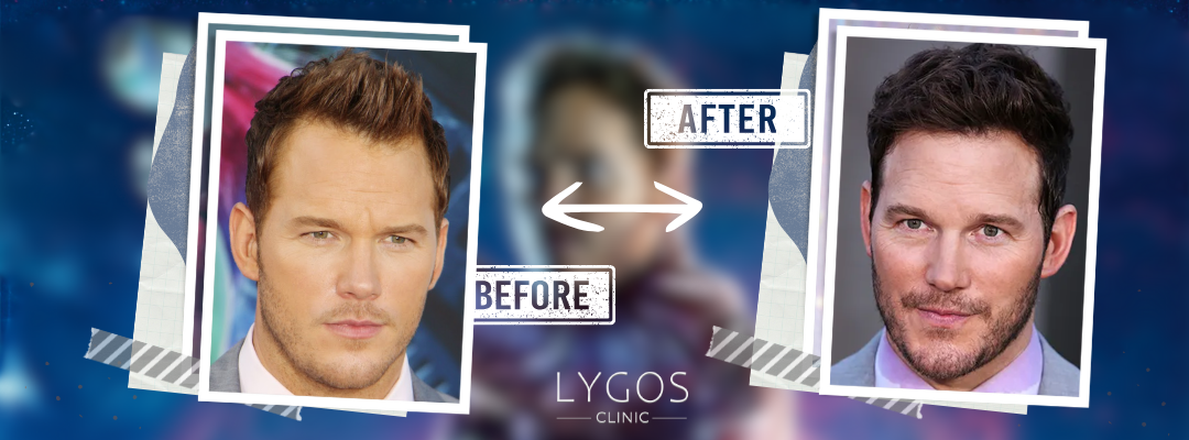 Chris Pratt Hair Transplant | Celebrities Hair Transplant 4 Chris Pratt Before and After Hair Transplant