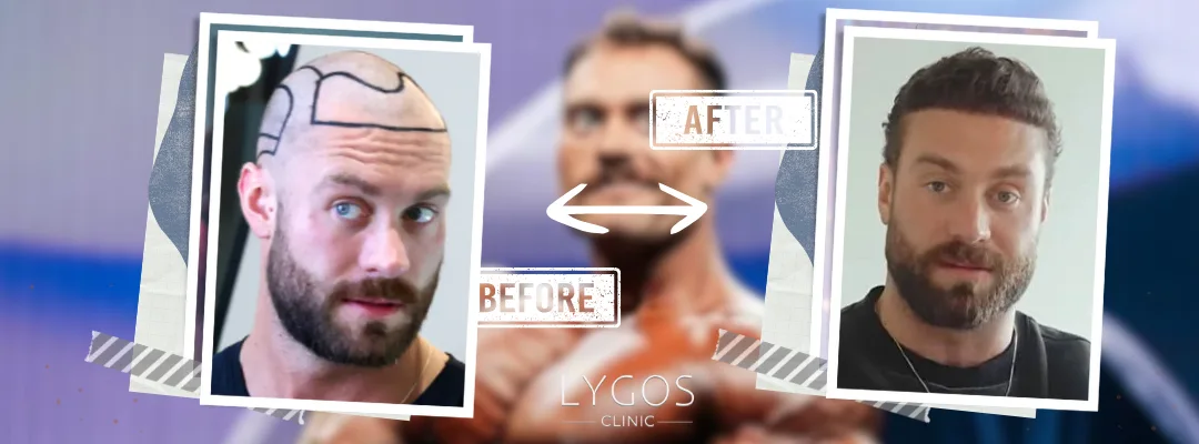 Chris Bumstead Before and After Hair Transplant