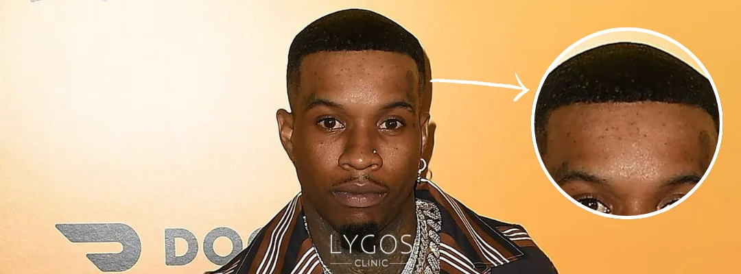 Tory Lanez Saç Ekimi | Ünlülerde Saç Ekimi 3 Did Tory Lanez Get a Hair Transplant?
