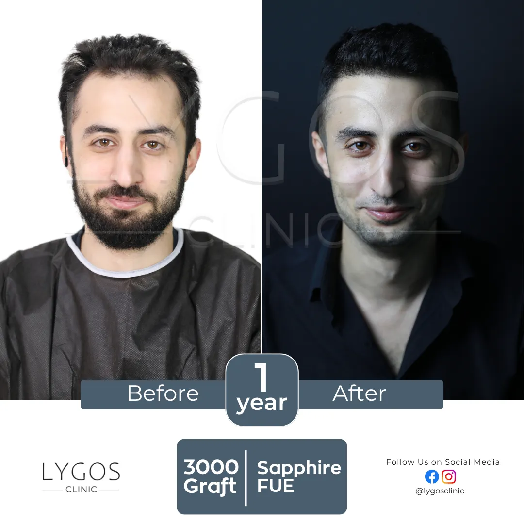 LYGOS CLINIC Hair Transplant | Plastic Surgery Health Center 63 square val hair transplant before and after images hair center of turkey (12)