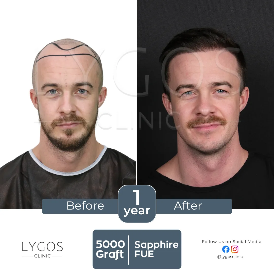 LYGOS CLINIC Hair Transplant | Plastic Surgery Health Center 55 square val hair transplant before and after images hair center of turkey (3)