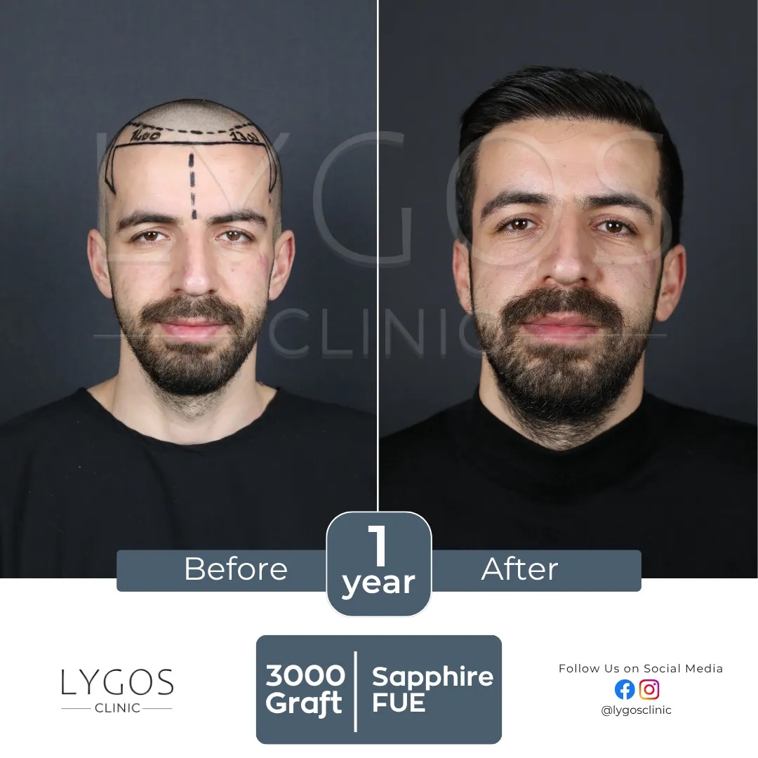 LYGOS CLINIC Hair Transplant | Plastic Surgery Health Center 56 square val hair transplant before and after images hair center of turkey (4)