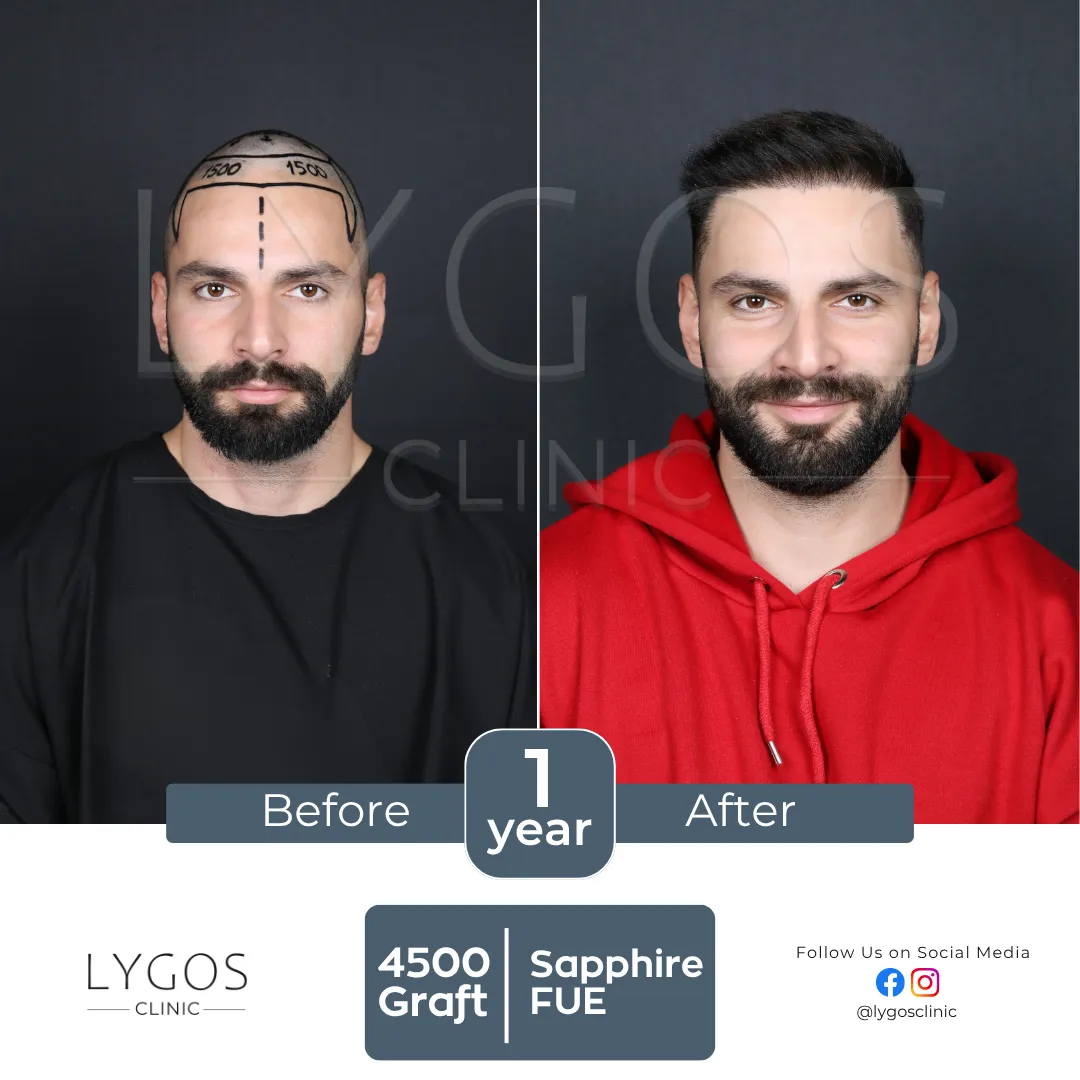 LYGOS CLINIC Hair Transplant | Plastic Surgery Health Center 57 square val hair transplant before and after images hair center of turkey (7)