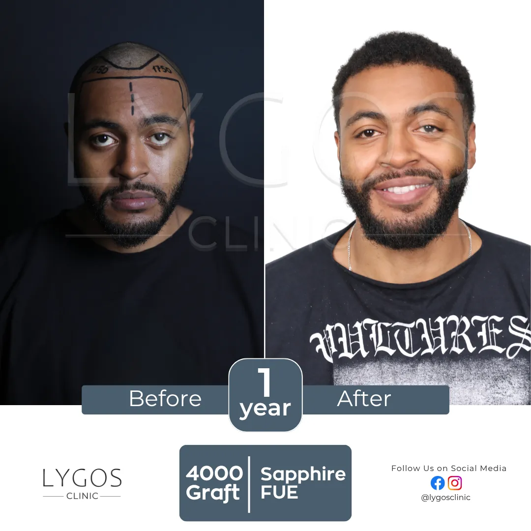LYGOS CLINIC Hair Transplant | Plastic Surgery Health Center 60 square val hair transplant before and after images hair center of turkey (8)