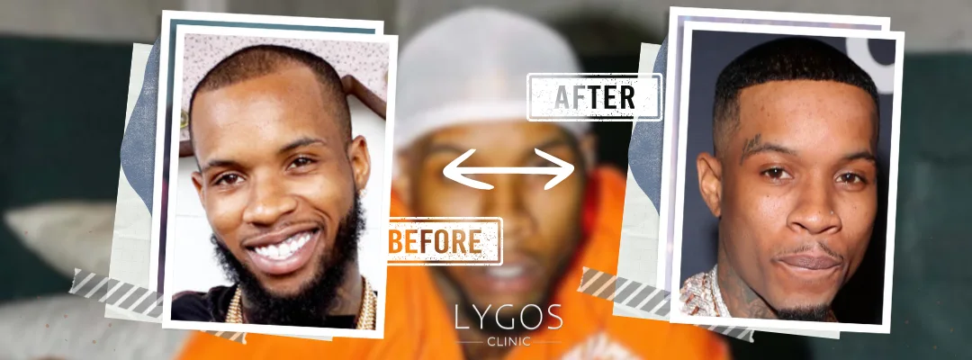 Tory Lanez Saç Ekimi | Ünlülerde Saç Ekimi 4 Tory Lanez Before and After Hair Transplant