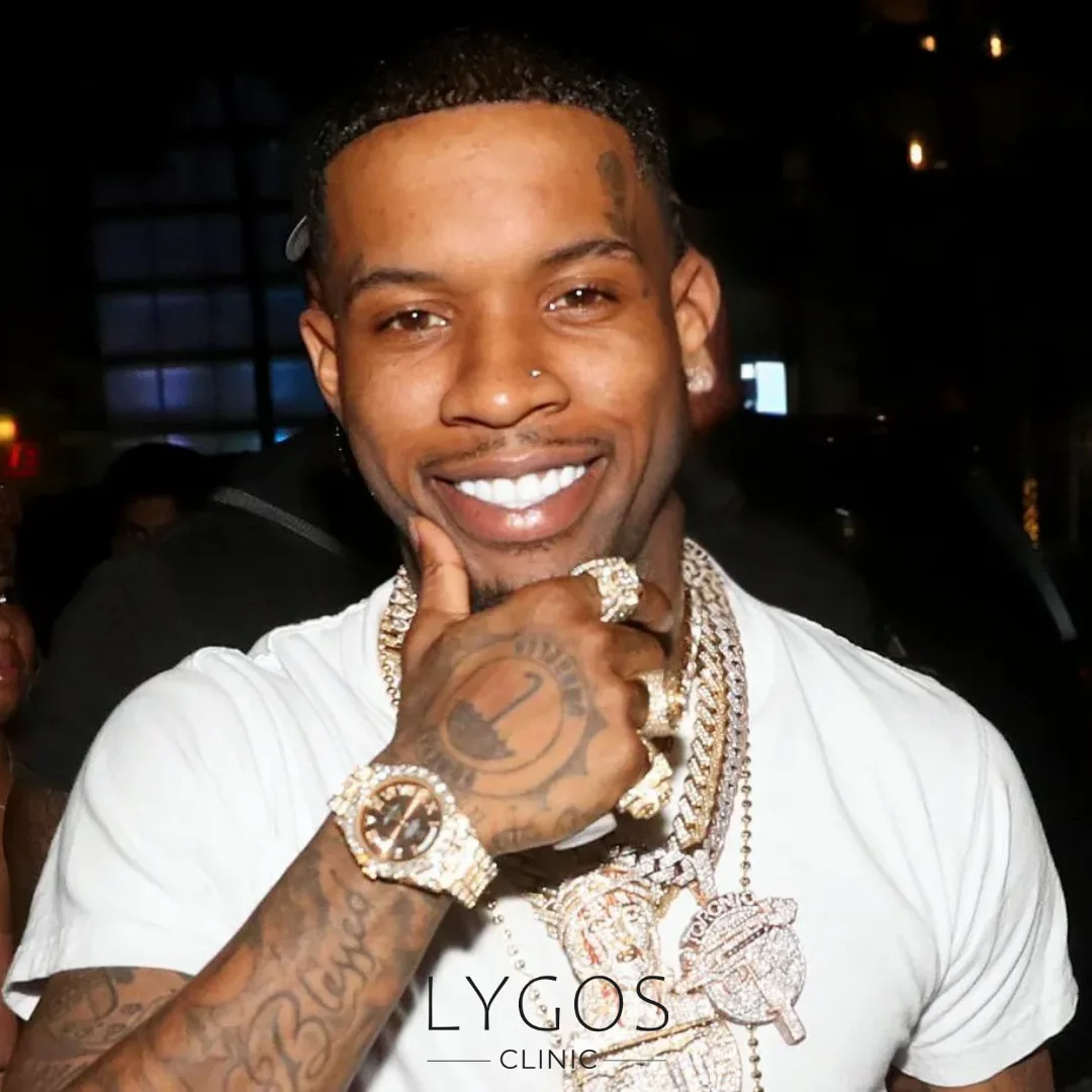 Tory Lanez Saç Ekimi | Ünlülerde Saç Ekimi 1 Tory Lanez Saç Ekimi