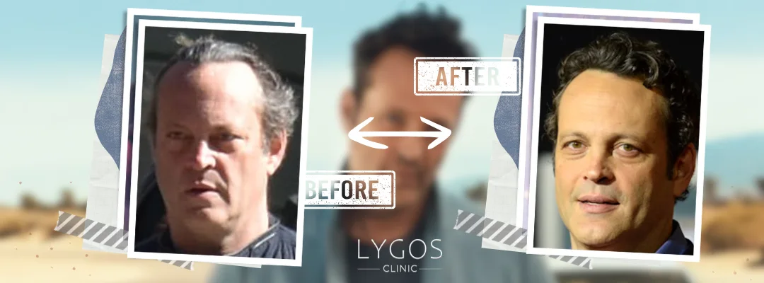 Vince Vaughn Before and After Hair Transplant