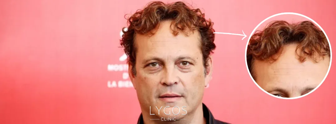 Did Vince Vaughn Get a Hair Transplant?