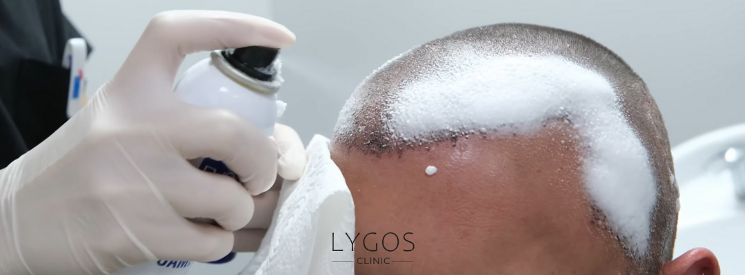 Expectations During the Hair Transplant Recovery Period 2 1 8