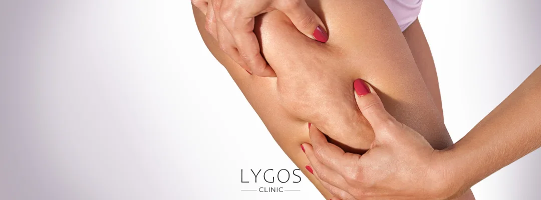 Cellulite Treatment Options | Effective and Scientific Approaches 2 What Is Cellulite