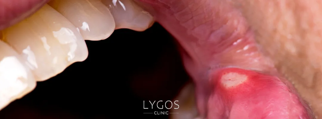 How to Get Rid of Canker Sores (Aft)? 2 1 result 23