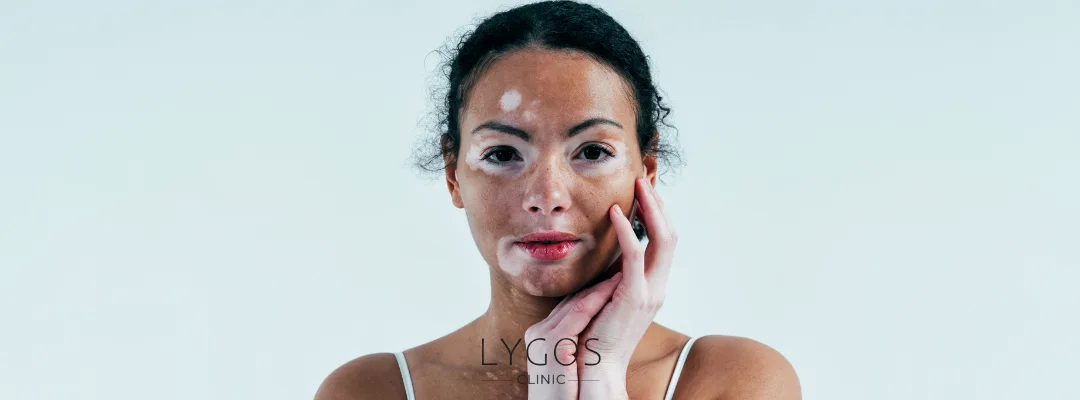 Causes of Alopecia Areata