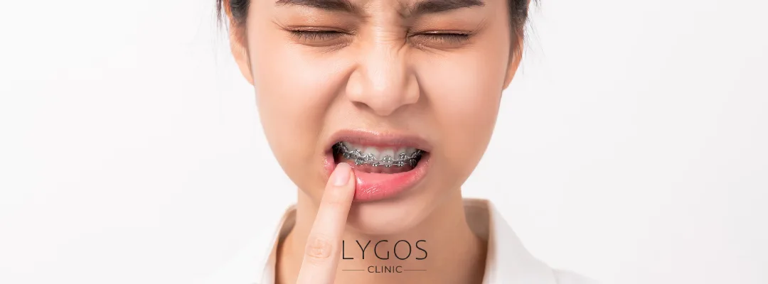 How to Get Rid of Canker Sores (Aft)? 3 2 result 22