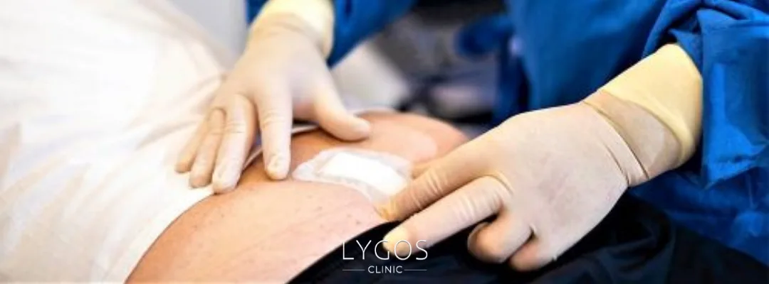 Kıl Dönmesi Nedir? | Kıl Dönmesi Tedavisi Nasıl Olur? 3 How Is Pilonidal Sinus Treated?