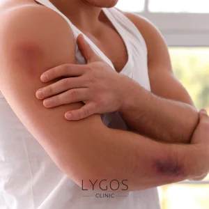 Genital (Vagina) Aesthetics 21 Why Bruising Occurs in the Body?