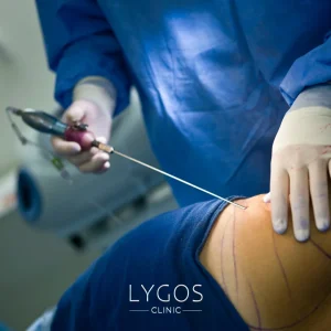 Vitrectomy 19 Liposuction Alternatives